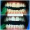 Igiene dentale professionale e sbiancamento click BLANCONE.